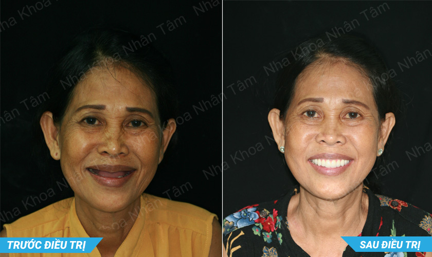 cay-ghep-implant-nhung-ly-do-khong-nen-tri-hoan2