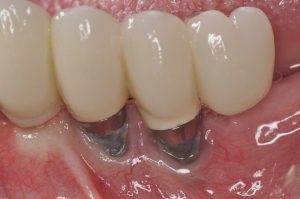 bia-ruou-anh-huong-nhu-the-nao-den-rang-implant2